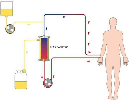 Механизм плазмафереза при лечении гепатита А