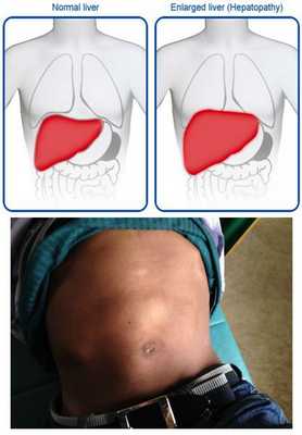 Резидуальное явление в виде увеличения печени