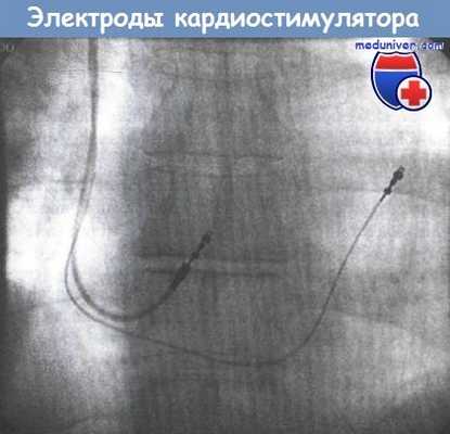 Электроды кардиостимулятора