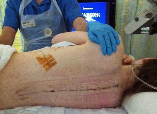 Операция по установке металлоконструкции на позвоночник относится к сложным хирургическим вмешательствам