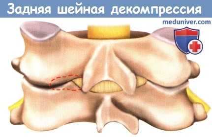 Техника операции задней шейной декомпрессии межпозвоночного отверстия