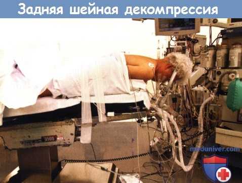 Положение пациента при задней шейной декомпрессии межпозвоночного отверстия