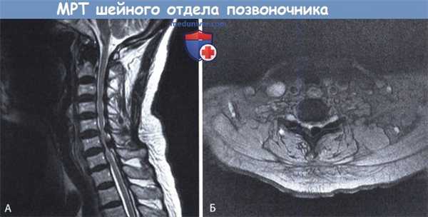 МРТ шейного отдела позвоночника