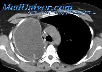 бронхогенные кисты