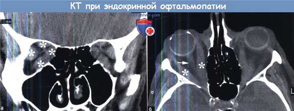 КТ при эндокринной офтальмопатии