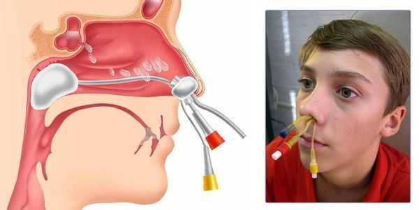 Синус-катетер ЯМИК