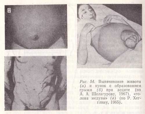 Выпячивание живота и пупок с образованием грыжи при асците, «голова медузы»