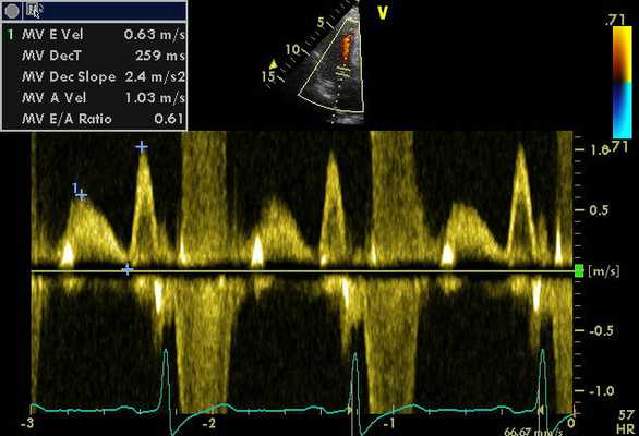 Допплерография сердца