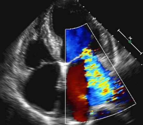 Эхокардиография с допплеровским анализом