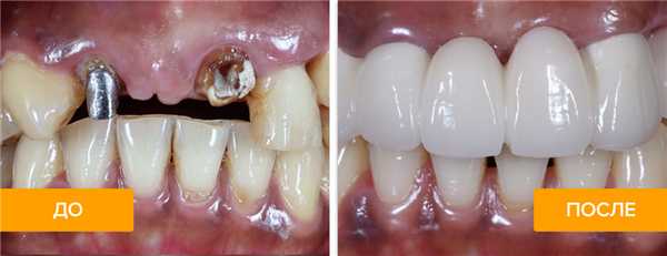 Фото пациента до и после установки мостовидного протеза