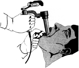 Эзофагоскопия