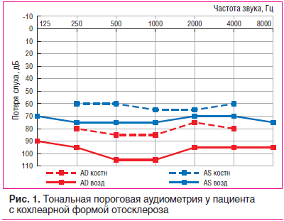 Рис. 1. Тональная пороговая аудиометрия у пациента с кохлеарной формой отосклероза