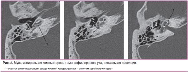 Рис. 2. Мультиспиральная компьютерная томография правого уха, аксиальная проекция.
