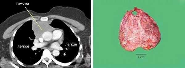 Опухоль вилочковой железы