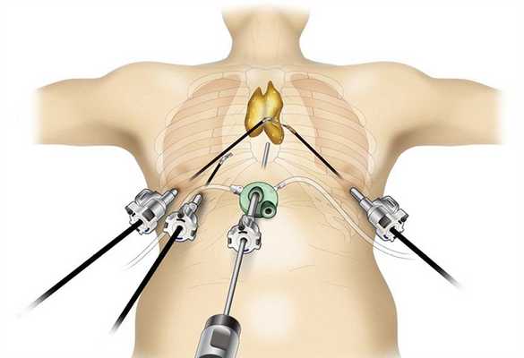 Лечение тимомы