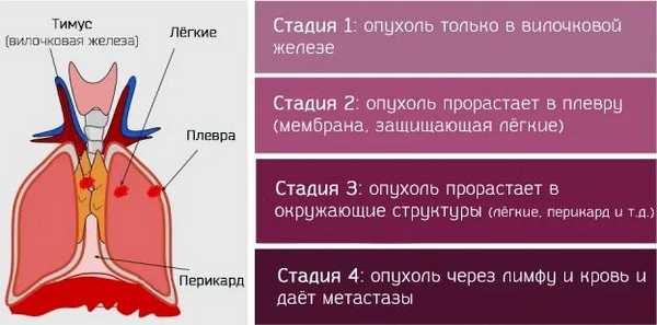 Стадии тимомы