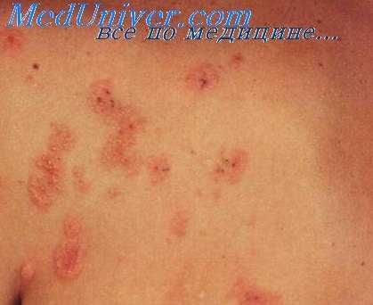 красные угри