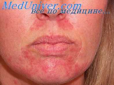 герпетиформное импетиго