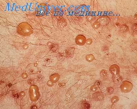 чешуйчатый лишай