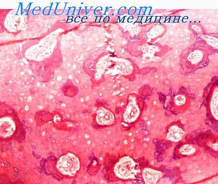 оссифицирующий миозит