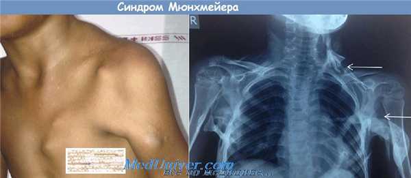 синдром Мюнхмейера