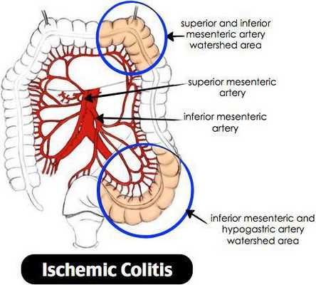 развитие колита