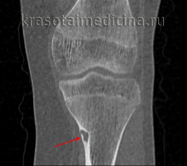 Гигантоклеточная опухоль кости