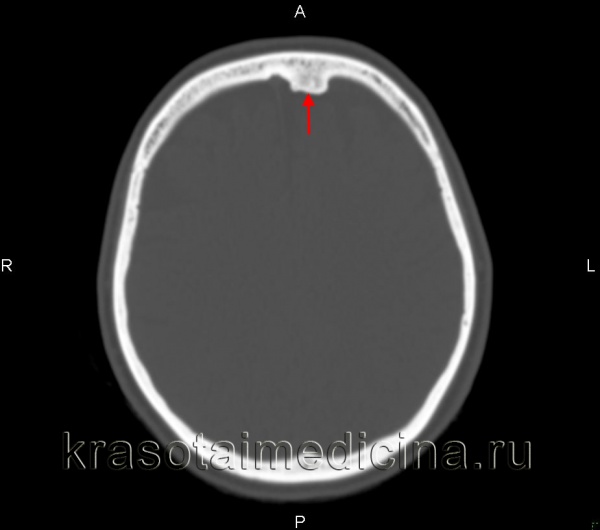 КТ головного мозга. Губчатая остеома левой лобной кости с пролабированием в полость черепа.