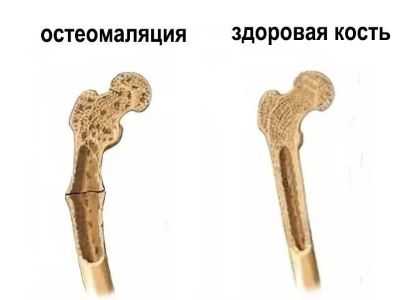 Остеомаляция