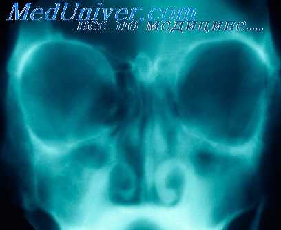 остеомы полости носа