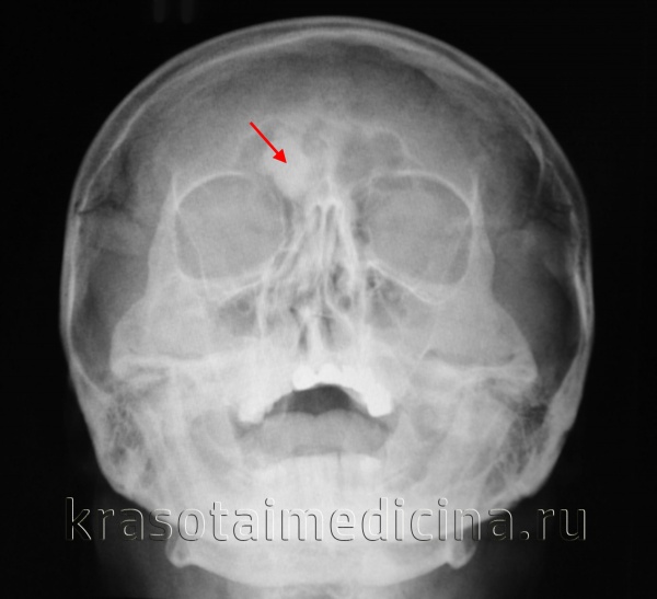 Доброкачественные опухоли полости носа