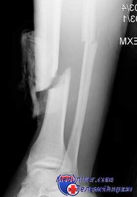 остеомиелит