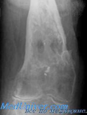 остеомиелит