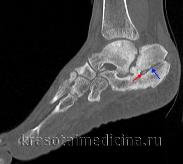 Хронический остеомиелит