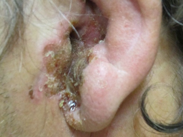 Злокачественный наружный отит. Сужение ушного канала, отек ушной раковины, большое количество экссудата