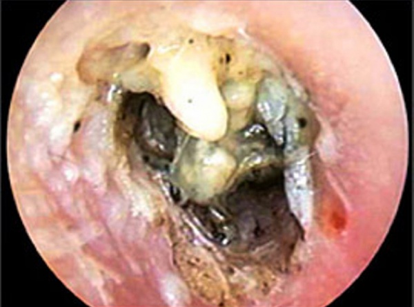 Отоскопическая картина при злокачественном наружном отите