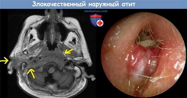 Злокачественный наружный отит
