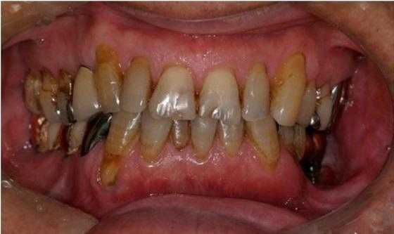 Клинический случай радионекроза челюсти и периимплантита после лучевой терапии