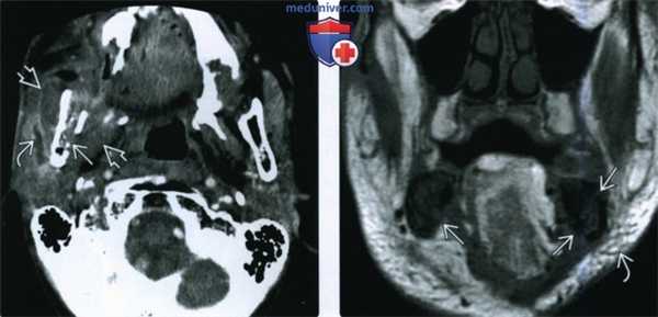КТ, МРТ при остеорадионекрозе нижней и верхней челюсти