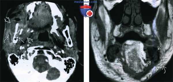 КТ, МРТ при остеорадионекрозе головы и шеи