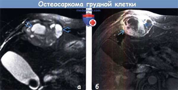 Остеосаркома грудной клетки на МРТ