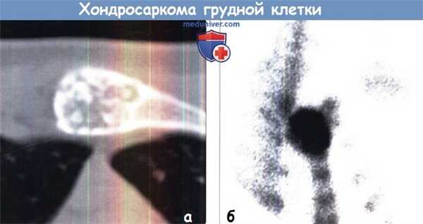 Хондросаркома грудной клетки на КТ, ПЭТ