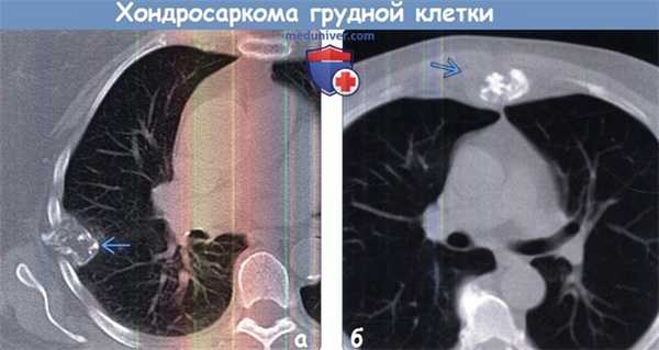 Хондросаркома грудной клетки на КТ
