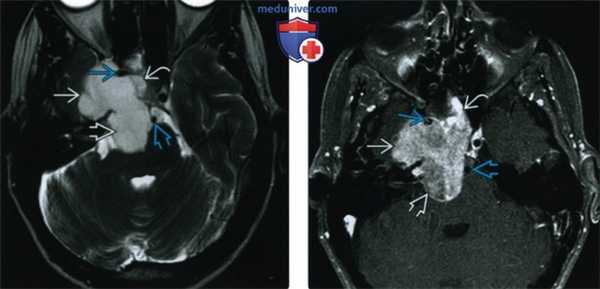 КТ, МРТ при хондросаркоме основания черепа