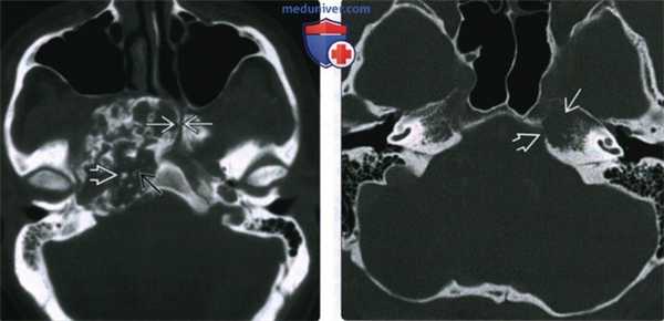 КТ, МРТ при хондросаркоме основания черепа