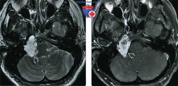 КТ, МРТ при хондросаркоме основания черепа
