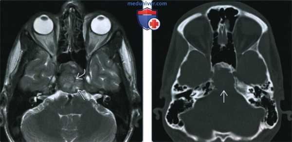 Остеосаркома основания черепа - лучевая диагностика