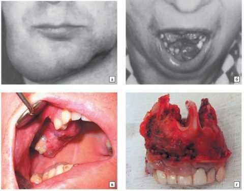 Клиническая картина остеогенной саркомы челюстей
