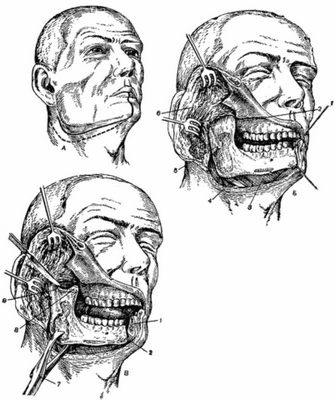 Резекция нижней челюсти.