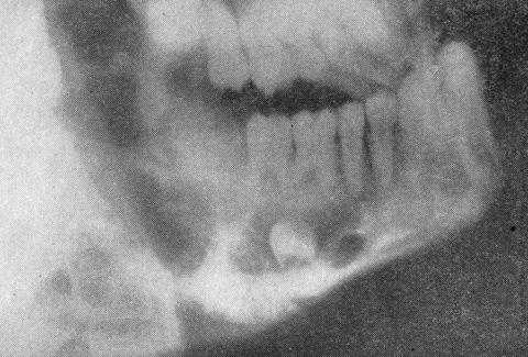 Рентгенография остесаркомы нижней челюсти